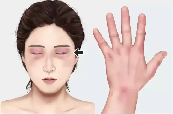 피부근염